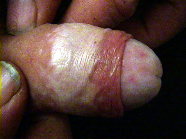 Lichen Sclerosus
